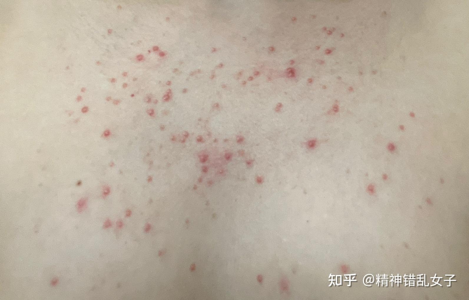 马拉色菌毛囊炎患者的痛苦