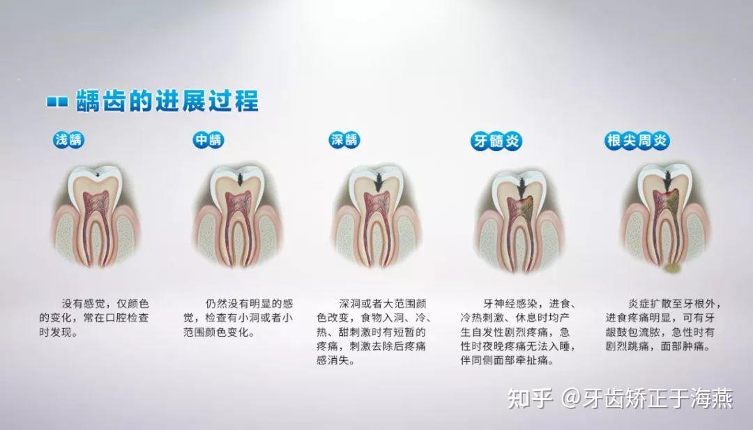 为什么医院不补浅龋齿