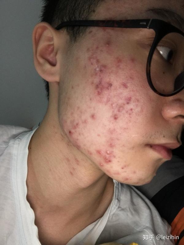 9月开始大烂脸