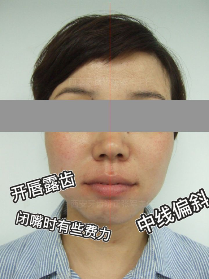 嘴突女孩如何通过正畸逆袭成为气质小姐姐丨西安牙齿矫正