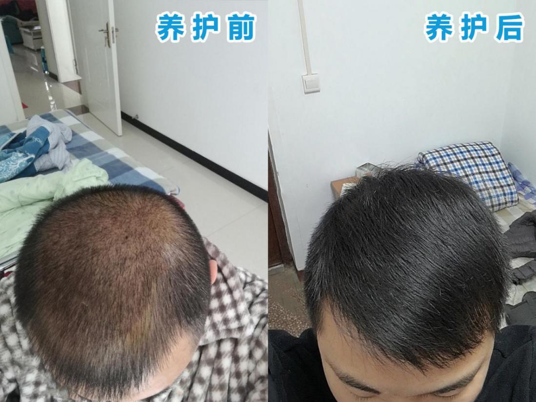 脂溢性脱发真的无法治愈吗?