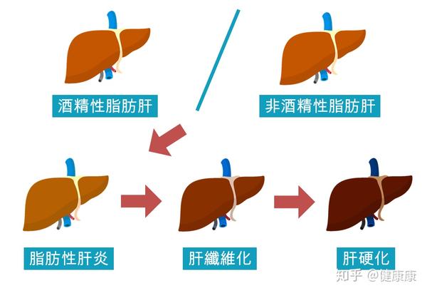 谈肝色变警惕脂肪肝这个沉默杀手日本专家倡食补预防