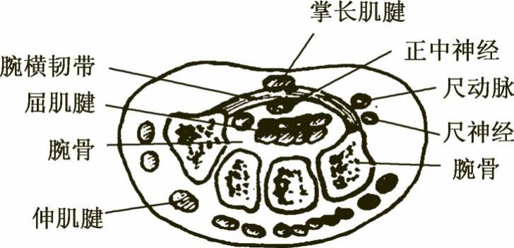 图8-10 腕管横切面解剖图腕管综合征是由于正中神经在腕管中受压,腕