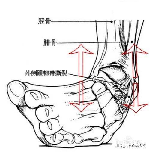 比如我们熟悉的"崴脚 就是因为脚踝关节外侧的韧带 被拉扯过度,产生