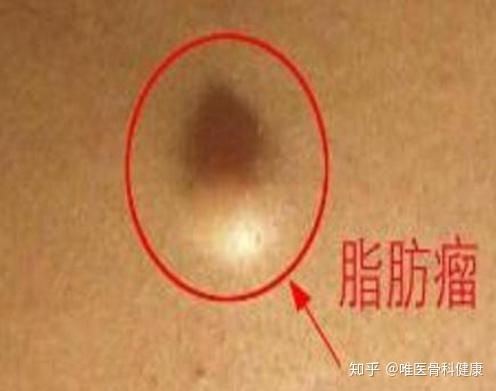 脂肪瘤的危害 zhuanlan.zhihu.com