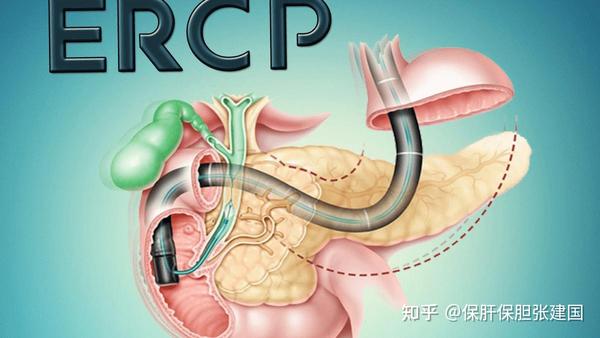 经口胆囊超级微创保胆取石手术和Ercp技术有哪些区别 知乎