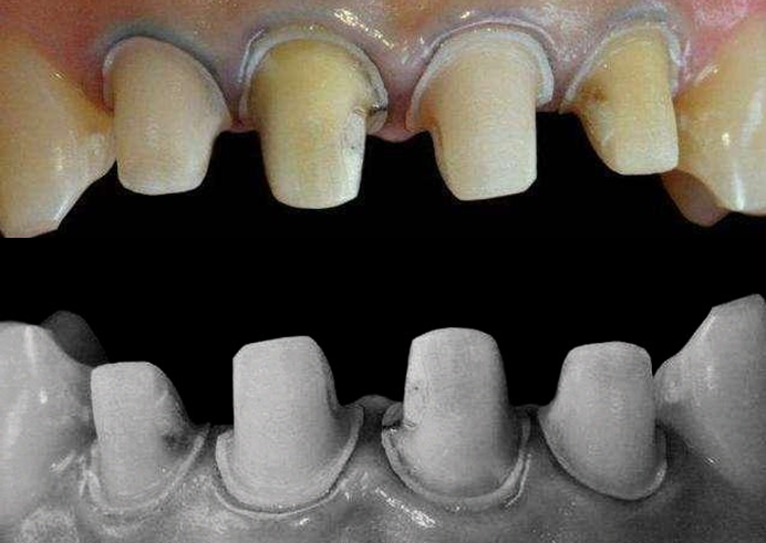 18岁女孩被磨了上下8颗牙齿通过烤瓷牙来纠正牙齿不齐可取吗