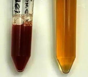 血尿(左)和正常尿液(右)图自:eclinpath