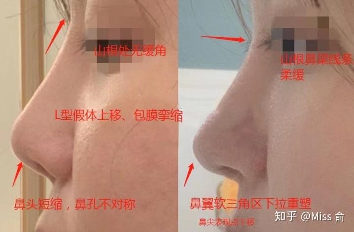 上海鼻修复鼻假体显形案例分享一