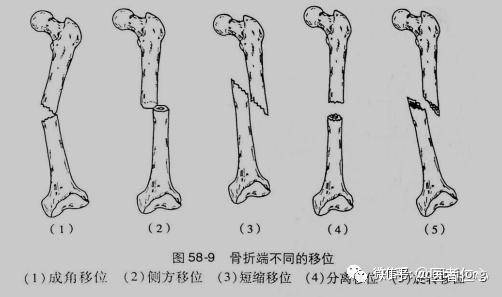 骨科英文书籍精读(3)|骨折移位和骨折愈合
