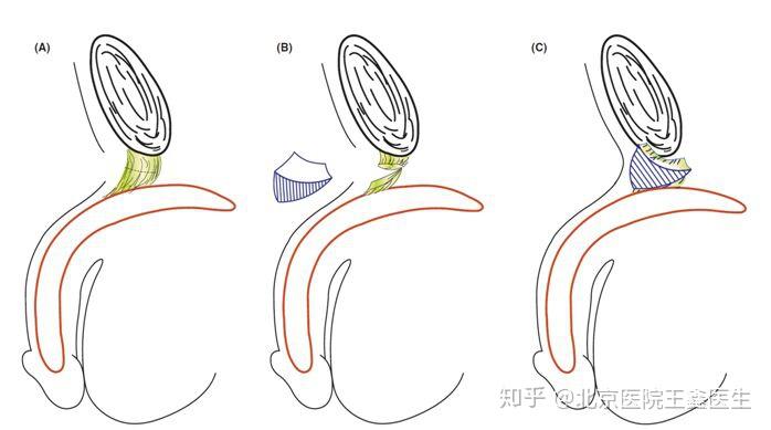 热点问答男性阴茎延长手术的原理是什么会造成勃起功能障碍吗