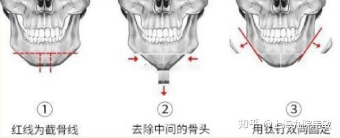 垫下巴和颏成形如何做出选择建议收藏