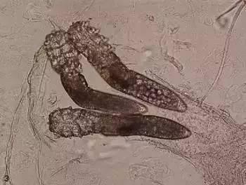 人类蠕形螨虫造成的皮肤病变有哪些?