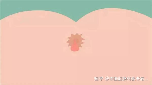 肛门处长疙瘩一定是痔疮也许是这些疾病在作怪