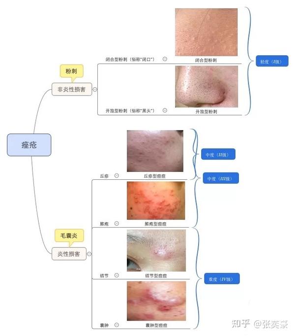 二.痘痘分类