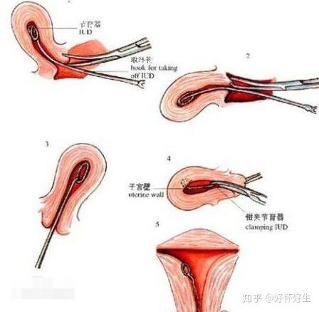取环后不休息可以吗 取环后需要卧床休息几天