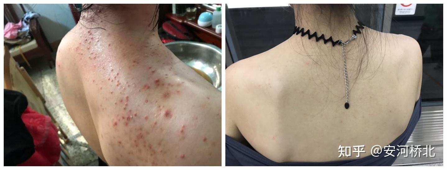 请问你们有谁长了毛囊炎好了的吗