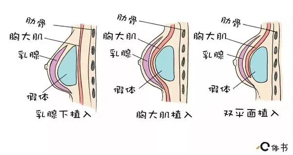 因为水滴形假体要维持这个特殊的形状,所以会适当硬一点.
