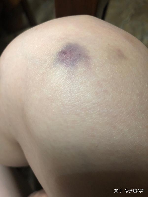 膝盖突然一块紫色的淤青,是紫癜吗……各位亲朋好友们