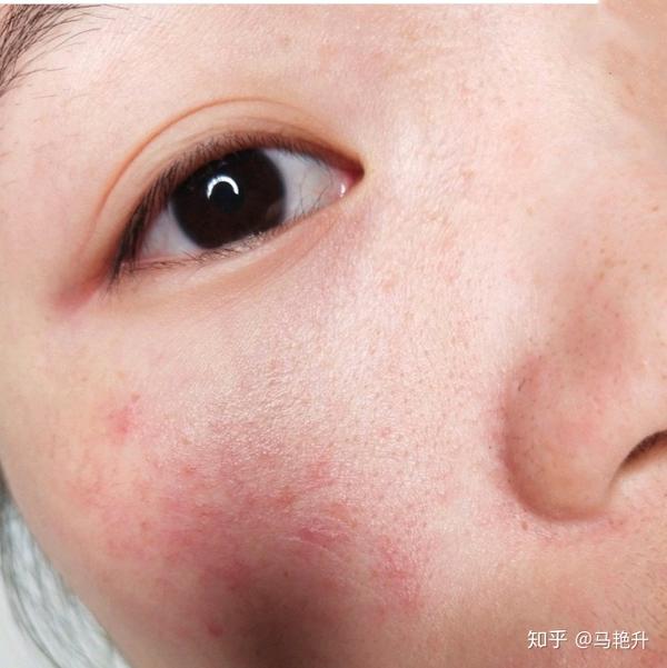 如何有效改善红血丝