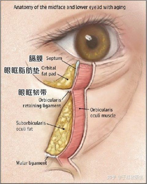 脂肪萎缩是形成眼袋的原因之一,再加上重力的影响,让眼眶脂肪往前膨出