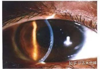 前葡萄膜炎症状累及虹膜,睫状体冠以前的睫状体,表现为视力下降,畏光