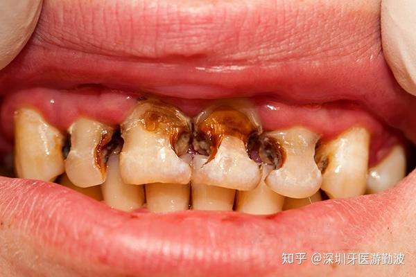 喝可乐久了牙齿会腐蚀掉?碳酸饮料到底对牙齿有什么危害?