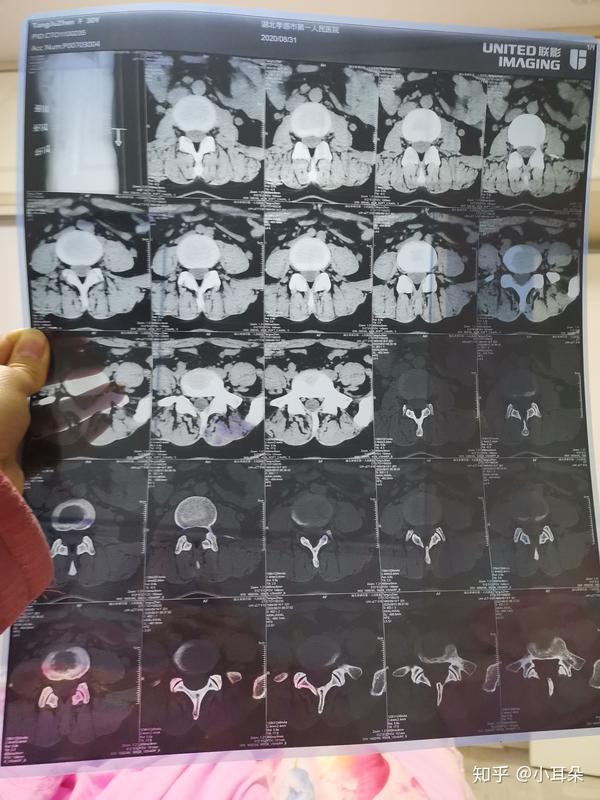 腰椎间盘突出,硬膜囊及双侧神经根受压怎么治序