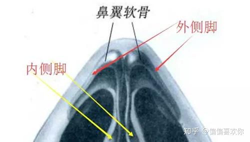 可以用手捏一捏,如果很软,就像没有支撑一样的鼻头,说明鼻翼软骨不