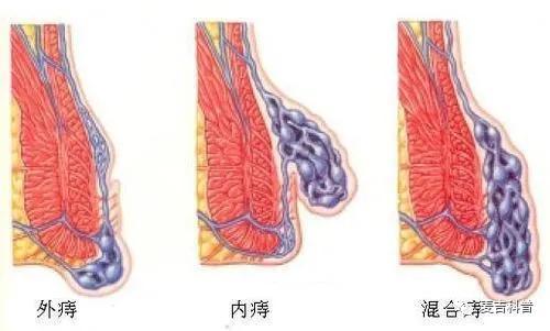 "十人九痔",你知道痔疮是怎么形成的吗?早点了解或能少受点罪