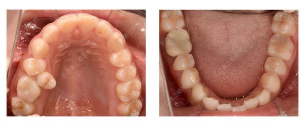 太原牙齿矫正于立涛上颌前突下前牙舌倾正畸案例