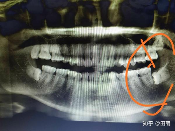 结果诊所很负责,建档案,拍全口牙片,结果发现四颗智齿 ,这不该有的长