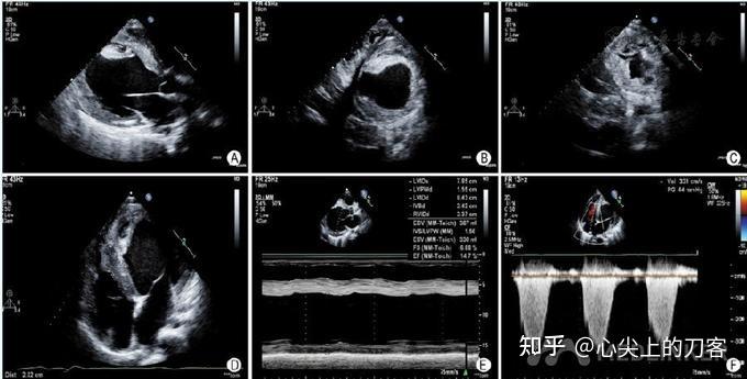 7 u/l,nt-probnp 8 516 ng/l,hs-tntt 181 ng/l;肝功能