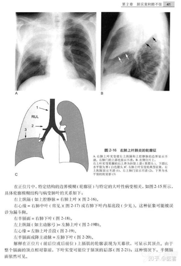 教科书上也很少见这么经典的胸片附肺实变的轮廓征图