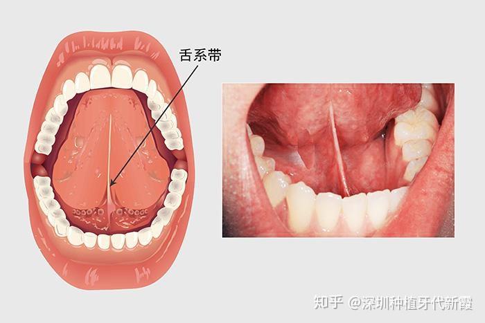 什么是舌系带短这会有什么影响吗该怎么判断舌系带短