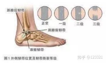 级:部分韧带纤维断裂,中等程度的疼痛和肿胀,活动度受限,可能存在关节