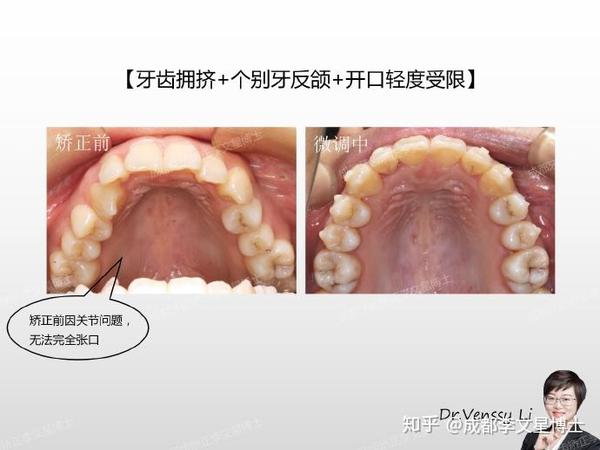 成都牙齿矫正李文星博士:『牙列拥挤 个别牙反颌』隐形矫正案例