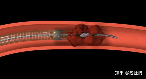 越来越多的证据表明, 导管抽吸装置可实现近似于 第二代支架取栓装置