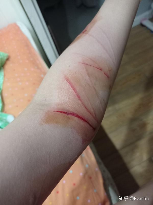 被家猫抓咬成这样要不要去医院处理伤口