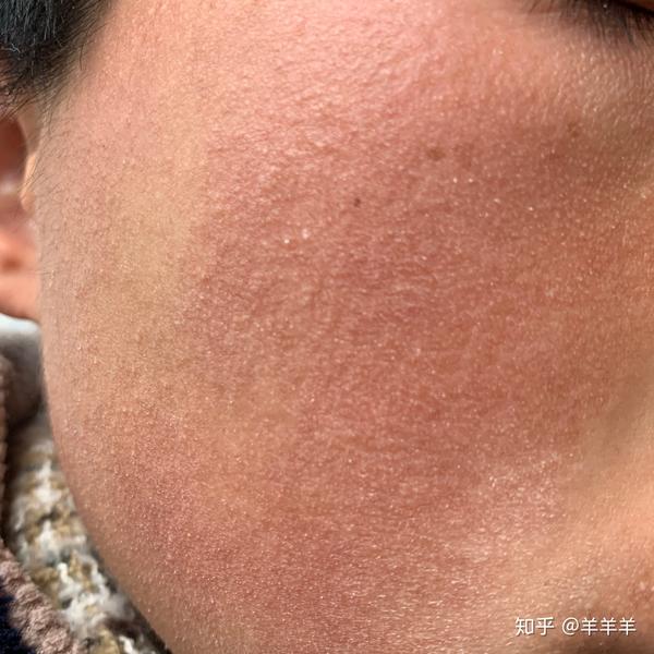 这是闭合型粉刺吗,好吓人,16岁,高一,不应该是压力大吧,也不熬夜