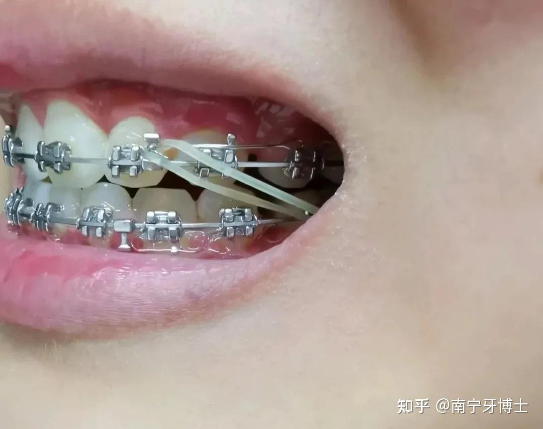 牙缝大等问题,挂在矫治装置(托槽,牵引钩)之间的皮筋,能在牙齿矫正的