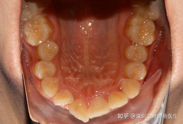 24,34,44(4颗4号牙),双侧上颌配合支抗钉排齐内收前牙,关闭拔牙间隙