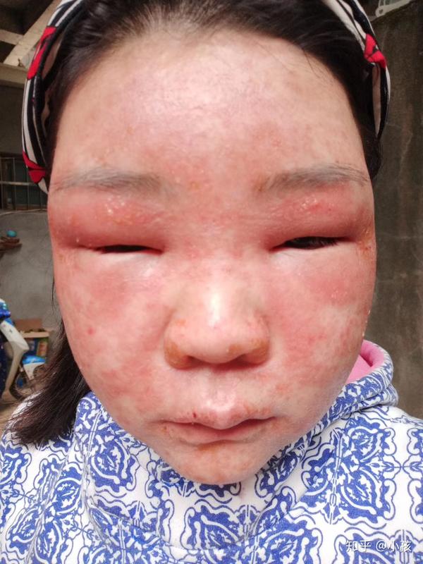 激素脸是什么激素脸该怎么处理