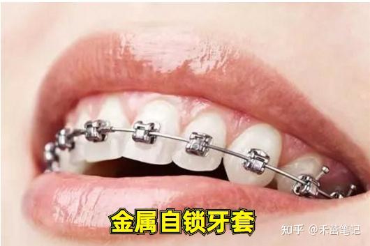 在拔牙矫正的案例中钢丝陶瓷牙套与国产时代天使进口隐适美哪个矫正