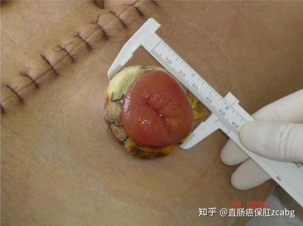 直肠癌冷冻保肛可行吗直肠癌患者做直肠支架的利弊分析