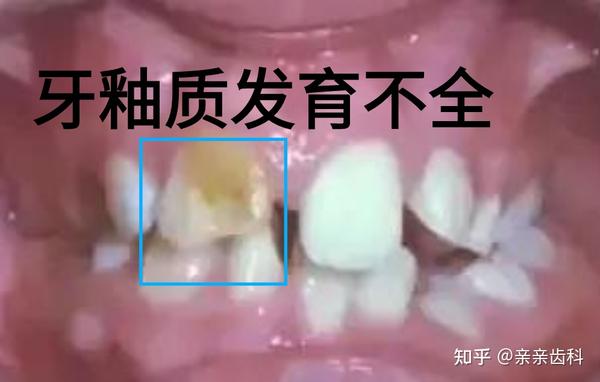 切除下颌骨摘了一颗眼球20颗乳牙全烂乳牙坏了有多严重实惨
