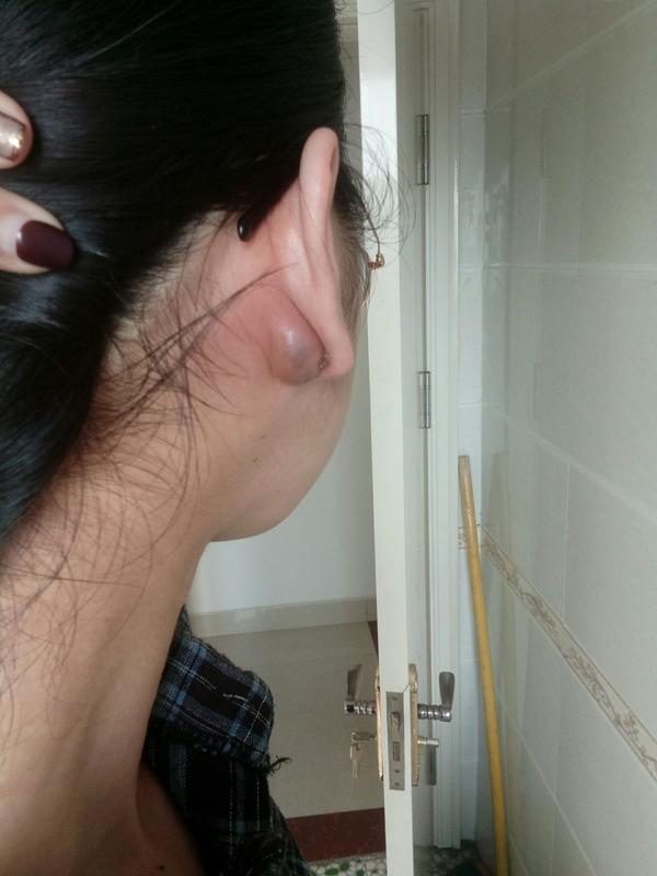 疤痕体质能打耳洞吗?