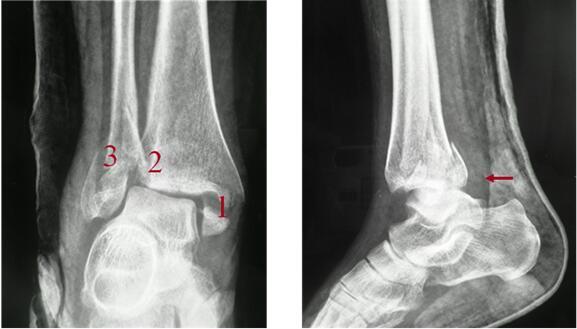 泻药三踝骨折即内踝,外踝和后踝同时发生不同程度的骨折或骨裂.