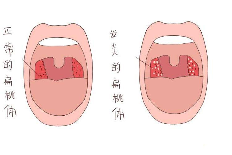 引起扁桃体炎的原因