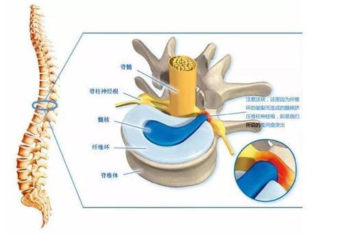 吉林大学中日联谊医院 疼痛科主任医师 2 人 赞同了该文章 腰突患者